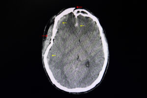 CT of a brain with traumatic injury from car crash in las vegas