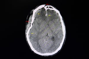 CT of a brain with traumatic injury from car crash in las vegas