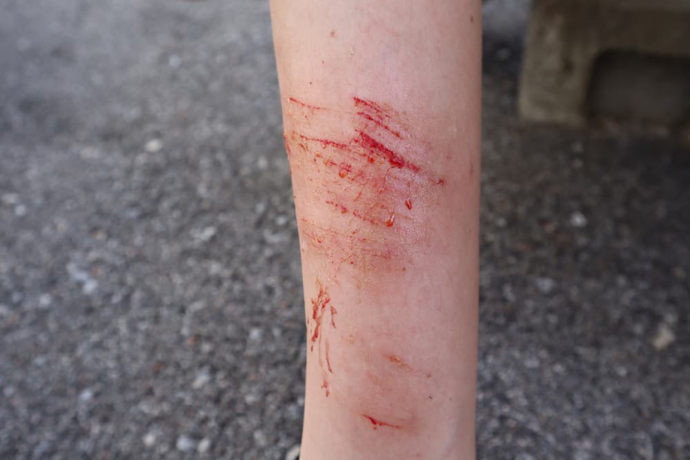 Road Rash Poses a Serious Health Risk and Can Cause Costly Medical Bills